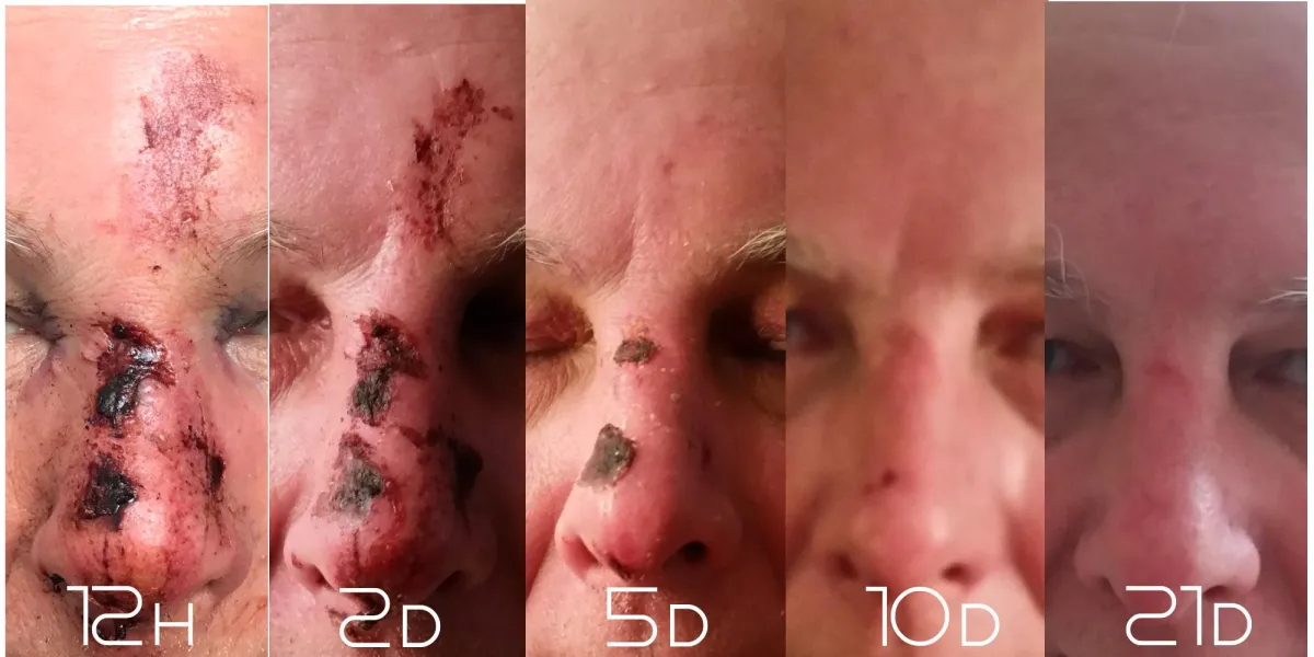 Anwendung Dr. Lanfermann® Tensidfreies Waschspray pH 12 innerhalb von 3 Wochen