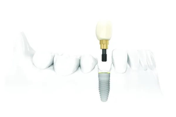 Zahnimplantate richtig pflegen - GZFA beschreibt, worauf es ankommt Bild: Zahnimplantate richtig pflegen - GZFA beschreibt, worauf es ankommt