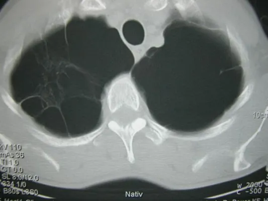 Bild: Helmholtz-Wissenschaftler suchen nach beteiligten Genen der Lungenkrankheit COPD