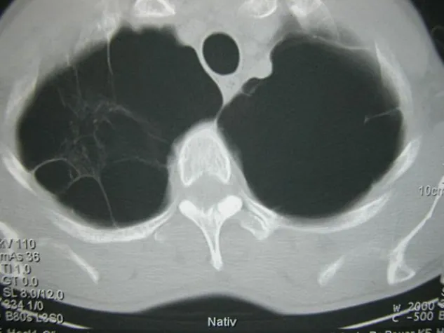 Helmholtz-Wissenschaftler suchen nach beteiligten Genen der Lungenkrankheit COPD Bild: Helmholtz-Wissenschaftler suchen nach beteiligten Genen der Lungenkrankheit COPD