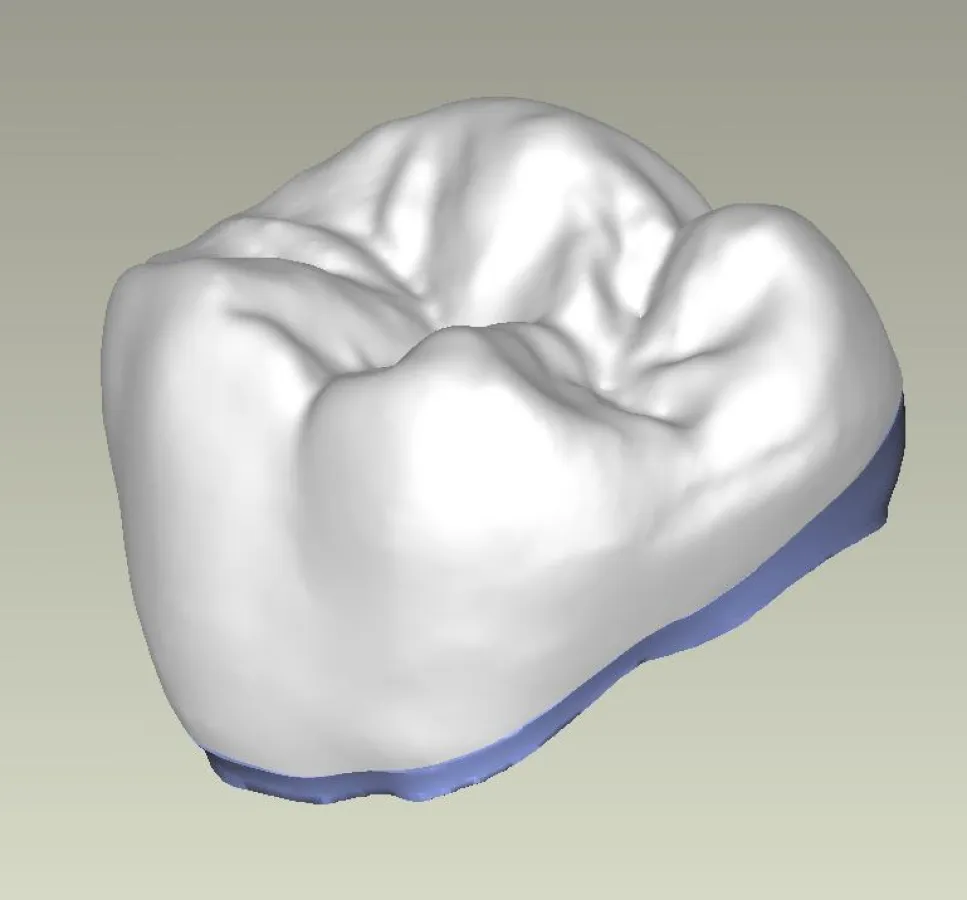 CAD/CAM Zirkonkrone (Sinterverbund)