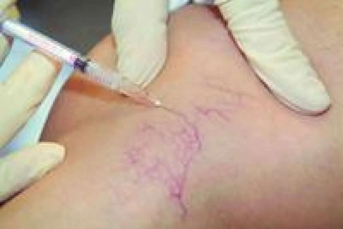 Die Mikroschaumverödung beseitigt Krampfadern und Besenreiser