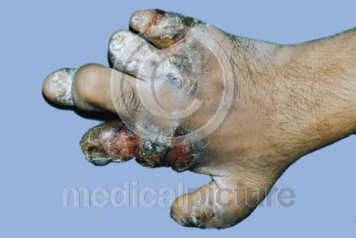 Bild: Welt Lepratag 2007 - medicalpicture mit Bildern und Informationen