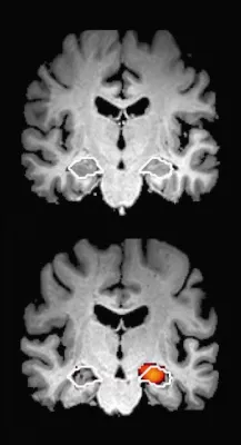 Bild: Alzheimer-Risikodiagnostik ist jetzt bundesweit wohnortnah verfügbar