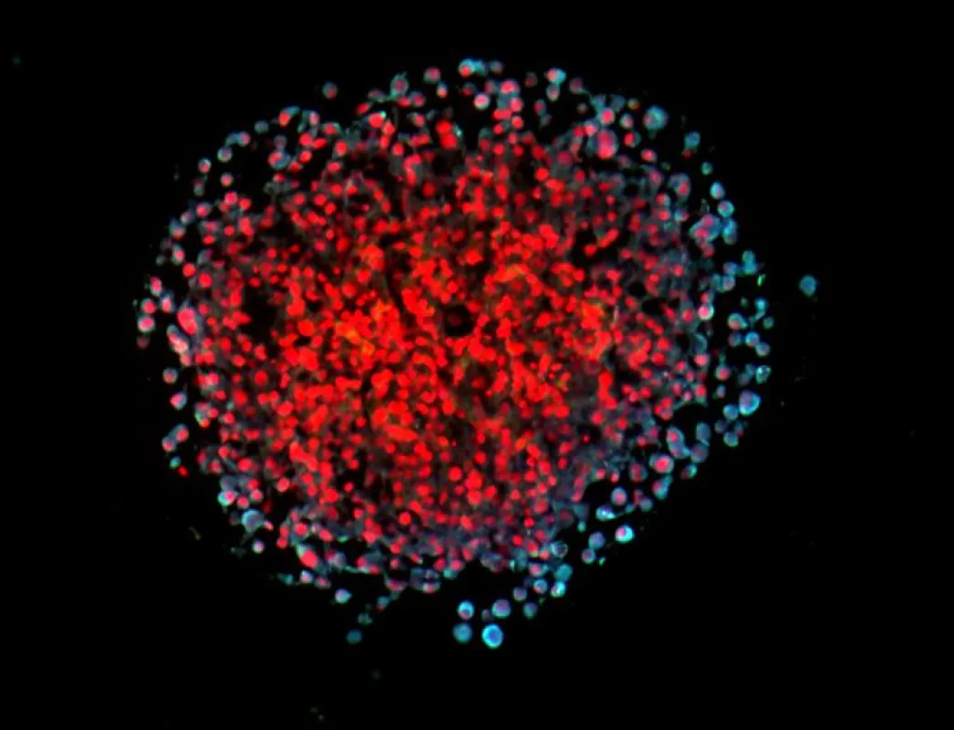 3D spheroid of cultivated breast cancer cells. Invasive cells show a light blue co-staining for the leptin receptor and a marker of the ability of cells to metastasize. Cell nuclei are stained in red.