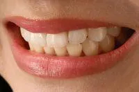 Bild: Farb- und Formkorrektur mit keramischen Verblendschalen (Veneers)