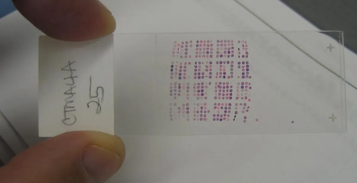 Mit weltweitem Computernetz unterstützt IBM die Krebsforschung