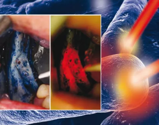 Bild: Eine innovative Möglichkeit zur Behandlung Bisphosphonat-assozierter Knochennekrosen: Die HELBO®-Therapie