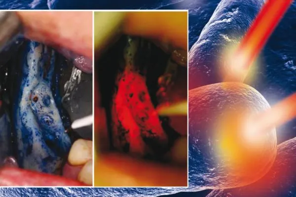 Bild: Eine innovative Möglichkeit zur Behandlung Bisphosphonat-assozierter Knochennekrosen: Die HELBO®-Therapie