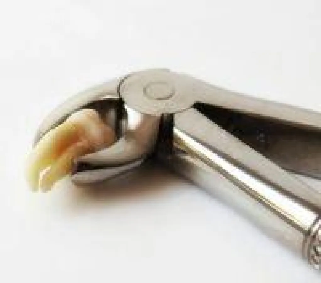 Weisheitszahn ziehen lassen