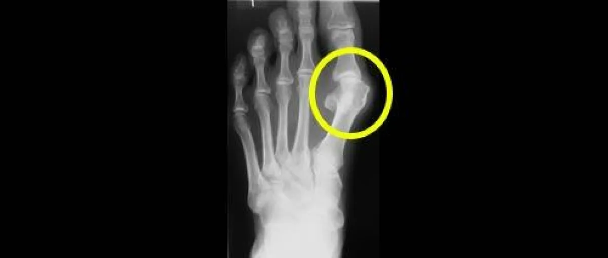 Typischer Hallux Valgus - Wann muss operiert werden ?