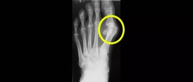 Bild: Hallux Valgus - Wann muss operiert werden ? Neue Trends in der Fußorthopädie