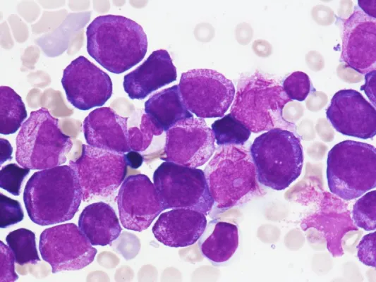 Bild: Neuer Ansatz zur Behandlung von Akuter Myeloischer Leukämie