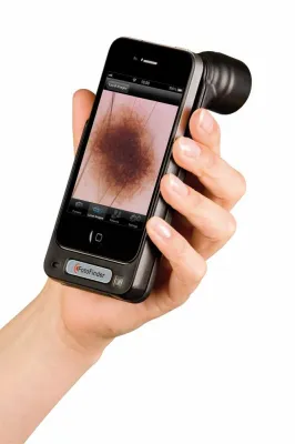 Bild: Hautkrebsdiagnostik mit dem iPhone