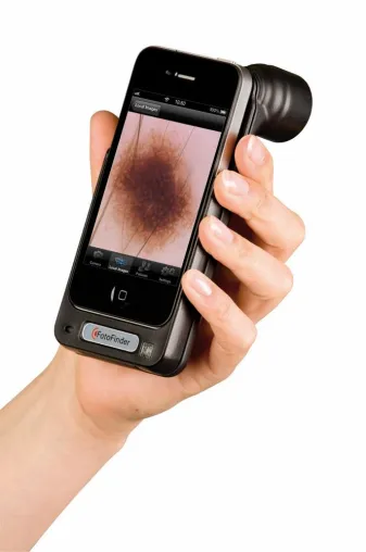 Bild: Hautkrebsdiagnostik mit dem iPhone