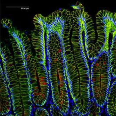 Bild: Magenkrebs: Auch Bakterien können Auslöser sein