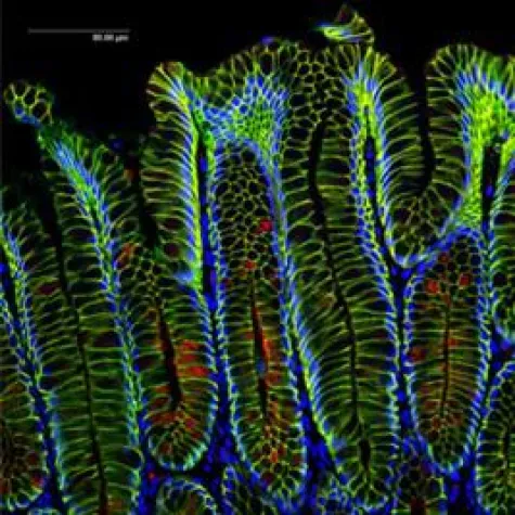 Bild: Magenkrebs: Auch Bakterien können Auslöser sein