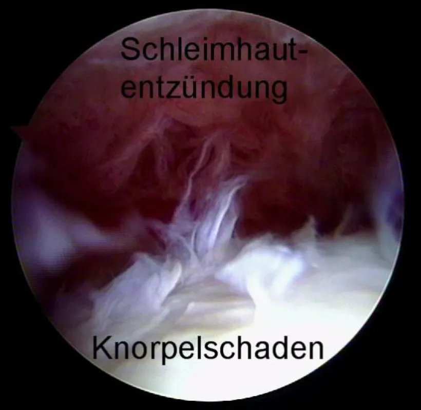 Ein Sturz auf die Hüfte kann zu Einreißen des Knorpels im Hüftgelenk führen, wie diese Arthroskopie zeigt. Unerkannt kann das zu schwerer Hüft-Arthrose führen. Quelle: www.gelenk-doktor.de