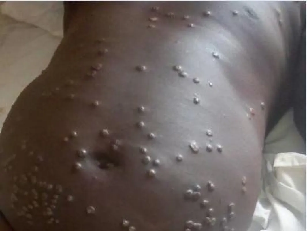 Patient mit Affenpocken im Bauchbereich. (Nigerianische Seuchenschutzbehörde)