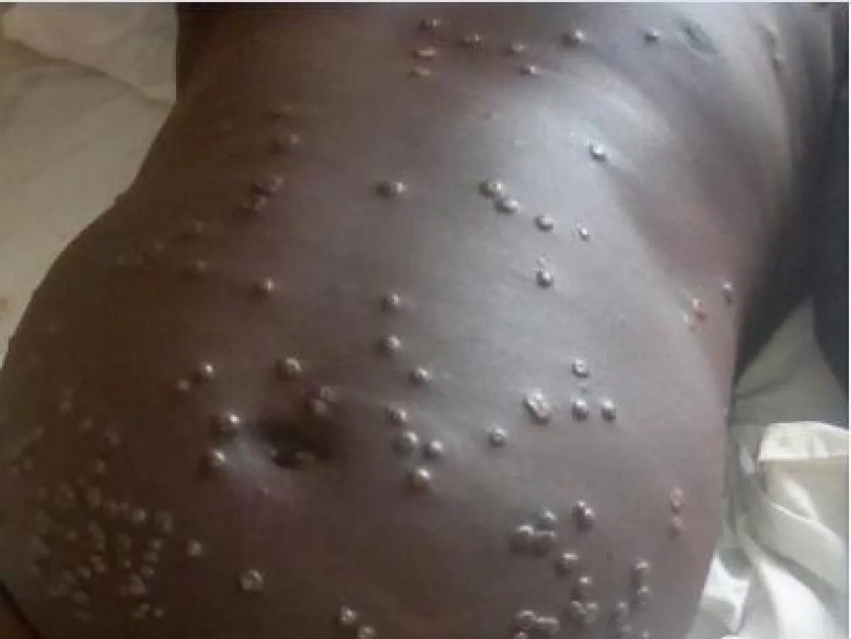 Patient mit Affenpocken im Bauchbereich. (Nigerianische Seuchenschutzbehörde)