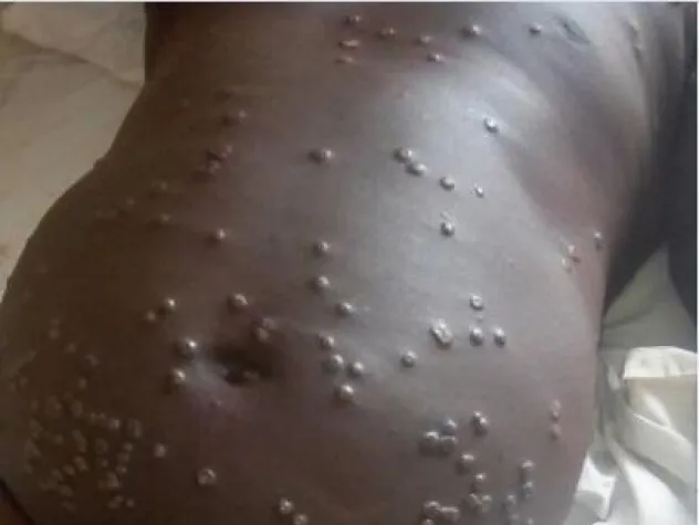 Bild: Neues Epidemie-Management-System bekämpft Affenpocken-Ausbruch in Nigeria