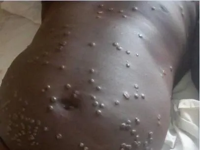 Bild: Neues Epidemie-Management-System bekämpft Affenpocken-Ausbruch in Nigeria