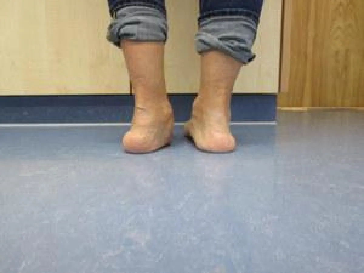 Der Knicksenkfuß ist eine der häufigsten Fußfehlstellungen