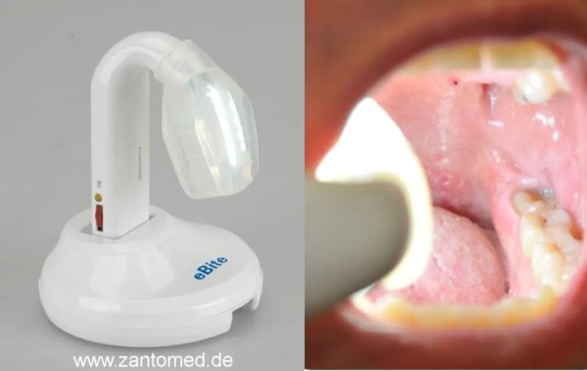 Das Zantomed Bite Light kombiniert einen bequemen Bißöffner mit idealer Ausleuchtung des intraoralen Raumes