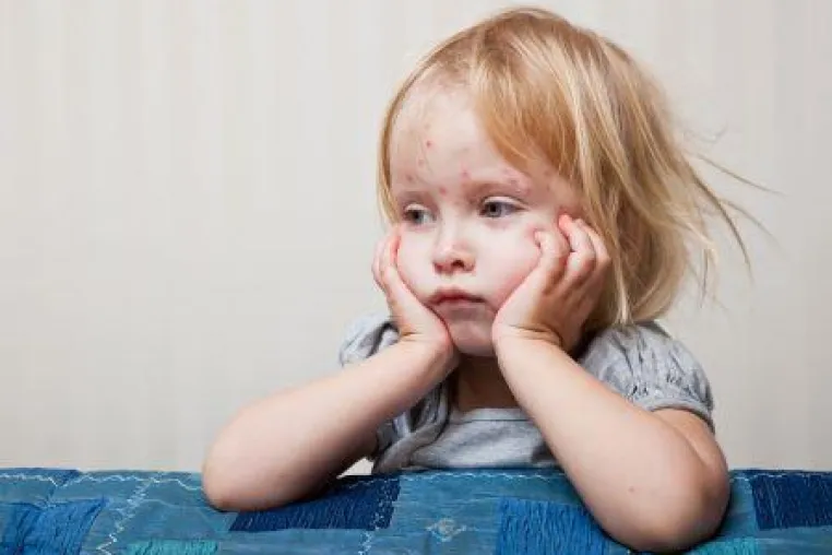 Info-Film: Impfung schützt Kleinkinder in der Kita vor Windpocken Bild: Info-Film: Impfung schützt Kleinkinder in der Kita vor Windpocken