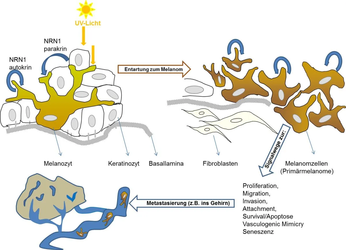 Das Wachstumsprotein Neuritin 1 (NRN1) kann in der Haut die Entstehung eines Melanoms fördern