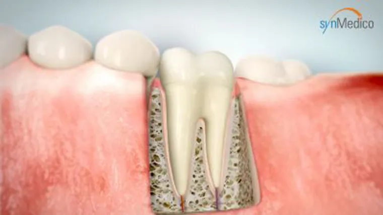 Bild: Wurzelbehandlung bei einem toten Zahn, welchen Sinn macht das?