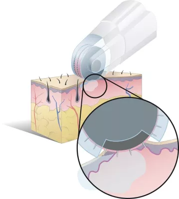 Bild: Innovation in der Faltenbehandlung: DermaFrac Dermalinfusion