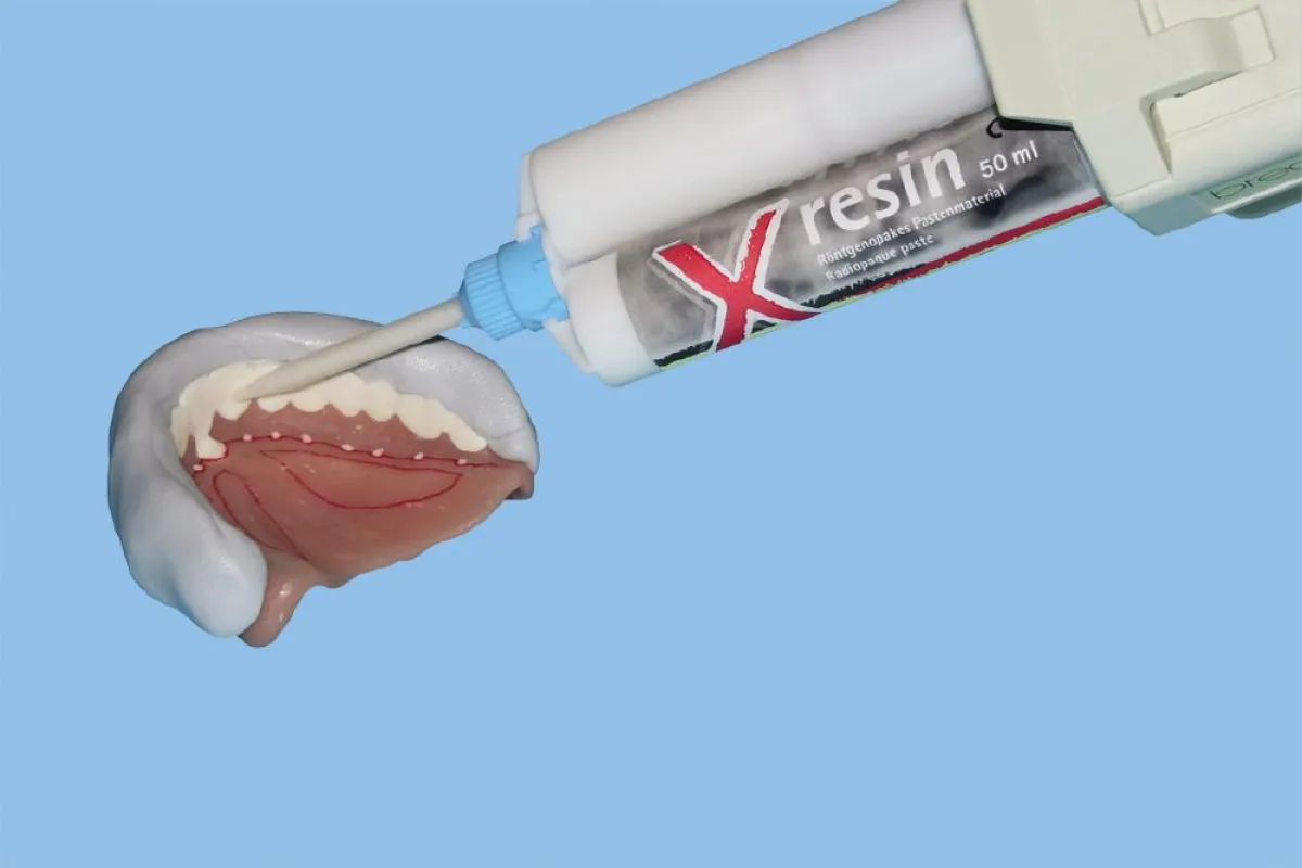 x-resin von bredent wird in den Vorwall eingespritzt.