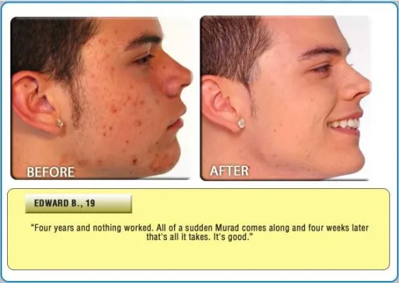 Bild: Starten Sie Akne frei in das neue Jahr mit dem Doctors Brand MURAD Acne