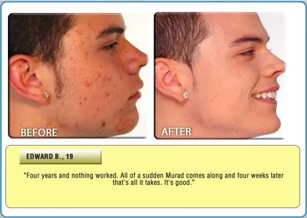 Starten Sie Akne frei in das neue Jahr mit dem Doctors Brand MURAD Acne Bild: Starten Sie Akne frei in das neue Jahr mit dem Doctors Brand MURAD Acne