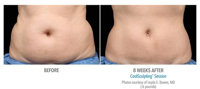 Bild: Neues Verfahren der Fettreduzierung