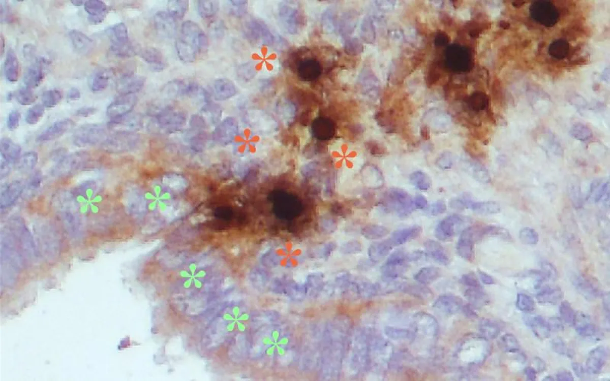 PIF (grün) moduliert die Immunzellen (rot) in der Endometriose (Mikroskopische Aufnahme) (Inselspital, Universitätsspital Bern)