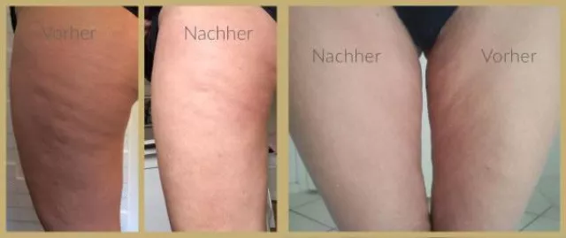 Bild: ByeByeCellulite - die revolutionare Creme von Dr. Juchheim Cosmetics