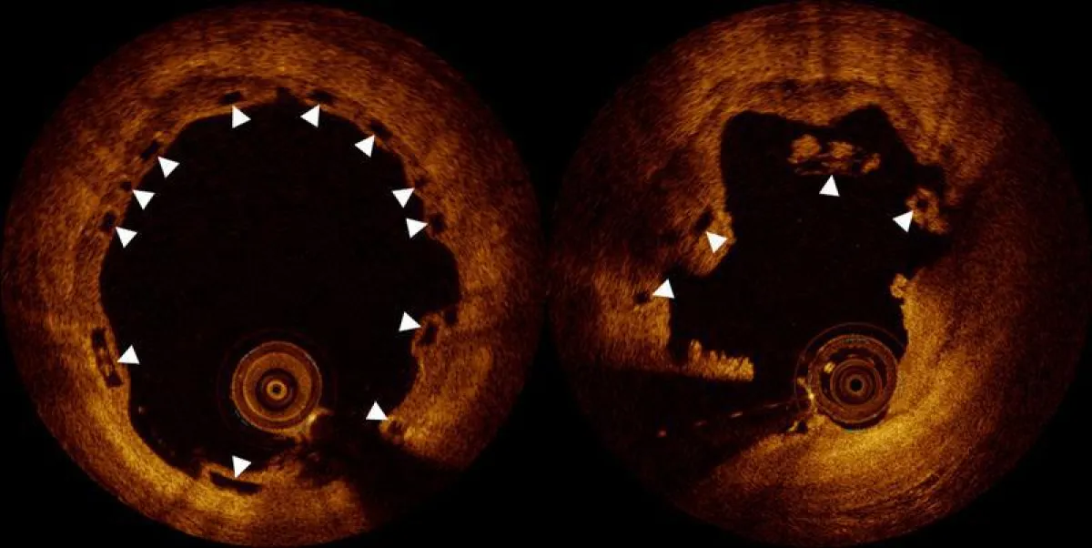 Obwohl zehn Monate nach Implantation die Position des Bio-Stents korrekt ist (links), sind sechs Monate später die Stentstreben eingebrochen (Optische Kohärenztomographie). (Inselspital, Universitätss