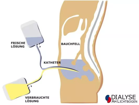 Bild: "Essener Dialysezentrum betreibt zu Gunsten der Lebensqualität Ihrer Patienten die Peritonealdialyse (PD)"