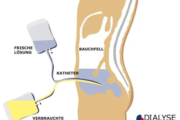 "Essener Dialysezentrum betreibt zu Gunsten der Lebensqualität Ihrer Patienten die Peritonealdialyse (PD)" Bild: "Essener Dialysezentrum betreibt zu Gunsten der Lebensqualität Ihrer Patienten die Peritonealdialyse (PD)"