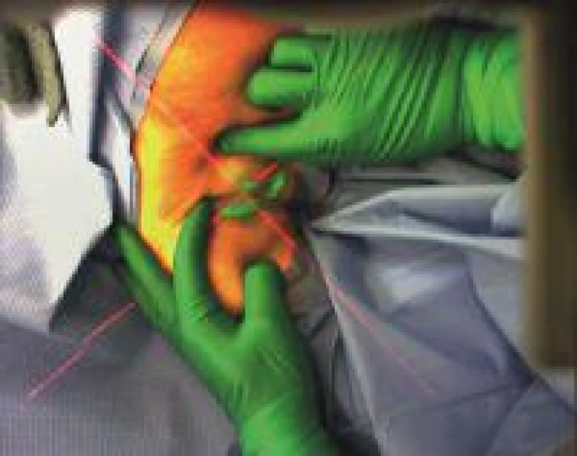 Die Position des Lymphknotens wird während der OP über eine AR-Brille virtuell eingeblendet. (Bildquelle: Nutzungsrechte: Fraunhof