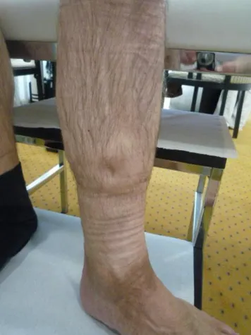 Bild: Offene Beine-Schlechte Versorgung Drama