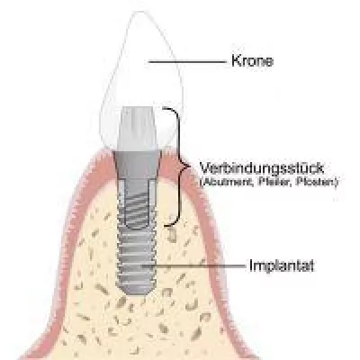 Bild: Welche Komplikationen können bei der Implantologie auftreten?