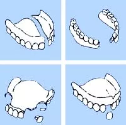 Wenn plötzlich die Zahnprothese bricht Bild: Wenn plötzlich die Zahnprothese bricht