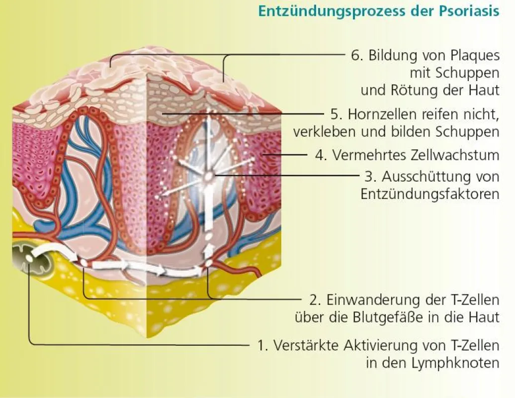 Entzündungsprozesse in der Haut führen zur Psoriasis (Quelle: Merck Serono)