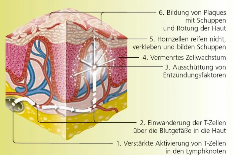 Bild: Schuppenflechte (Psoriasis): Wenn das Immunsystem die Haut angreift