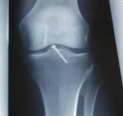 Bild: Kasko für die Knochen - Unfallversicherung jetzt auch für Berufssportler