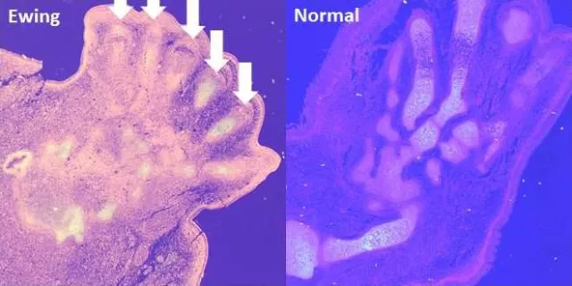 Bild: Jagd nach der Ursprungszelle des Ewing-Sarkoms erfolgreich