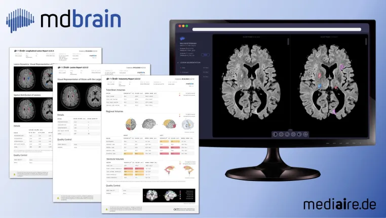 Bild: Neue KI-basierte Software-Lösung für Radiologen verbessert und beschleunigt die Demenzdiagnostik